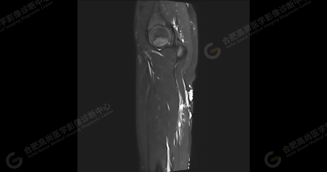 【高尚病例】软组织血管瘤 1 例