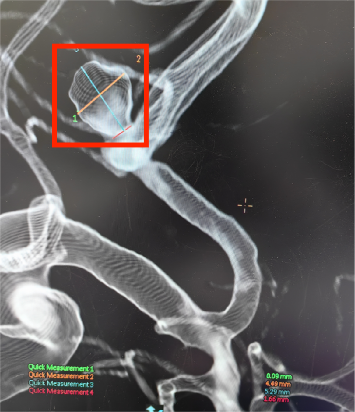 南京江北医院神经外科成功开展颅内动脉瘤弹簧圈栓塞术