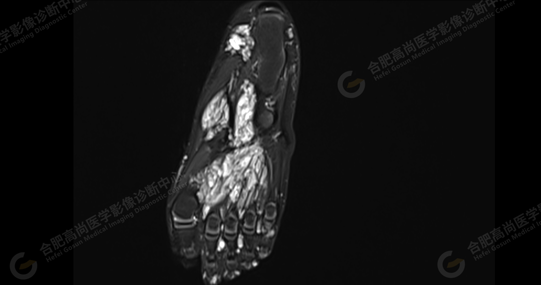 【高尚病例】软组织血管瘤 1 例