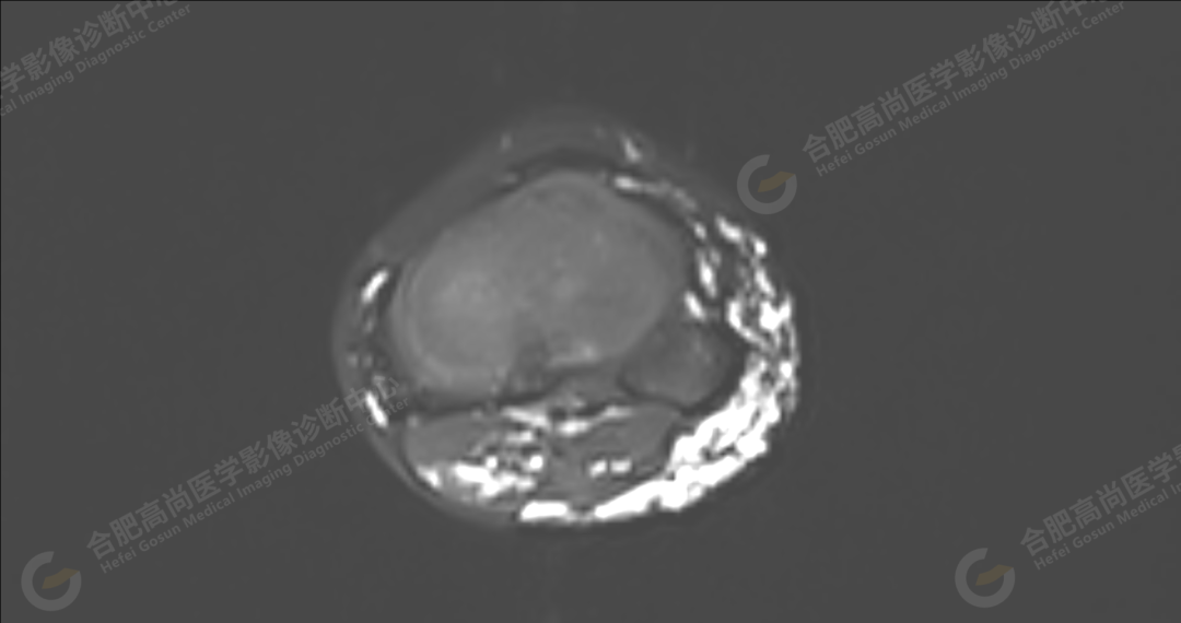 【高尚病例】软组织血管瘤 1 例