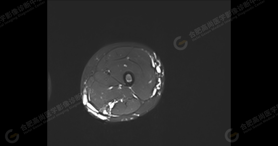 【高尚病例】软组织血管瘤 1 例