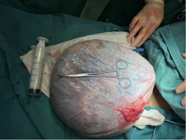 泰州市人民医院多学科诊疗为患者切除巨大肿瘤