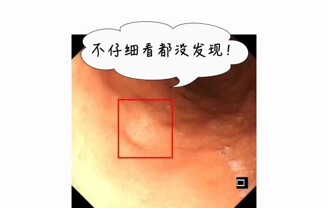 认准这个「戒指」，专在胃里搞「杀猪盘」！50 岁阿姨险没命