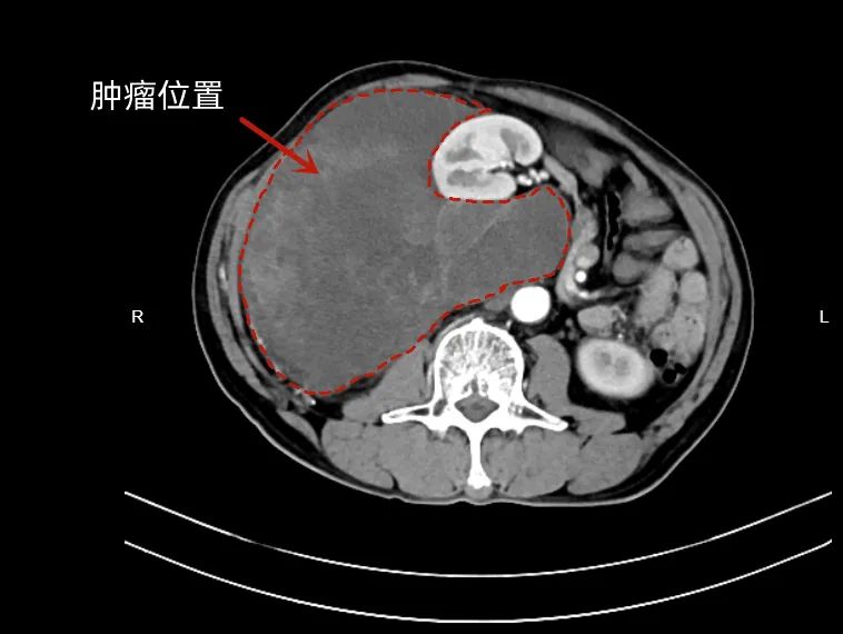 六旬老人身怀 6 斤肿瘤，台州市肿瘤医院胃肠团队精准拆弹