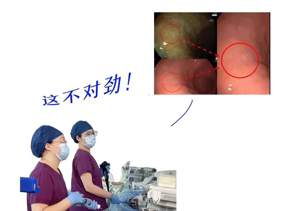 认准这个「戒指」，专在胃里搞「杀猪盘」！50 岁阿姨险没命