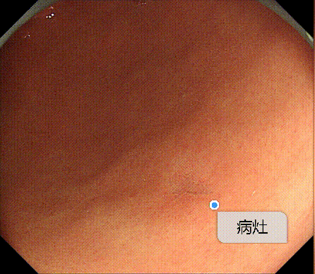 认准这个「戒指」，专在胃里搞「杀猪盘」！50 岁阿姨险没命