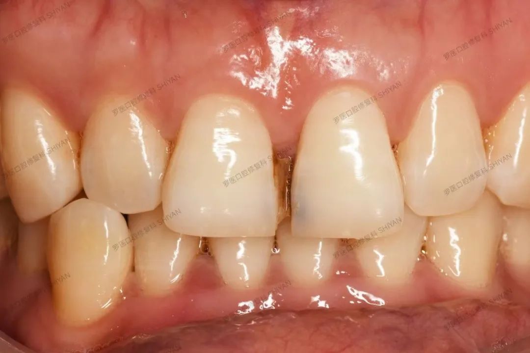 牙医说：瓷贴面虽好，但不是人人都适合