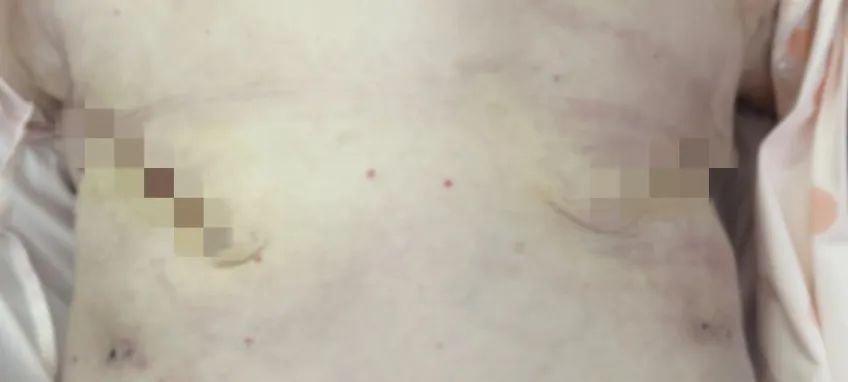 得了乳腺癌，全切「保命」还是保乳？且听吴秀萍怎么说