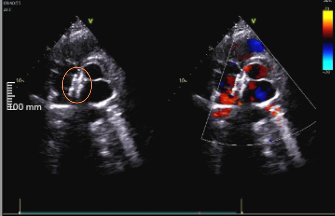常州市第二人民医院成功开展生物可降解卵圆孔未闭封堵器植入术