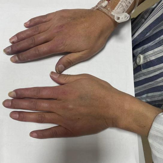 手指遇冷变色？小心「雷诺现象」