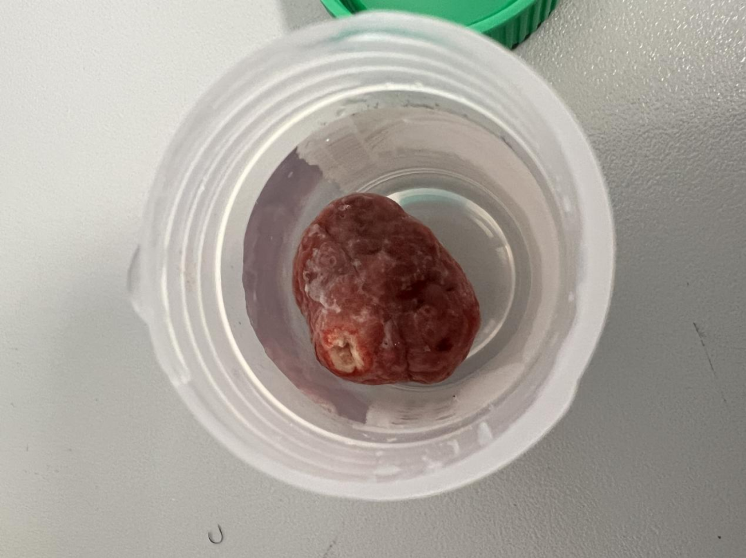 6 岁女童便血半年，不知道的还以为是……
