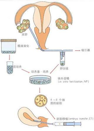 专家解析：人工授精和试管婴儿的区别