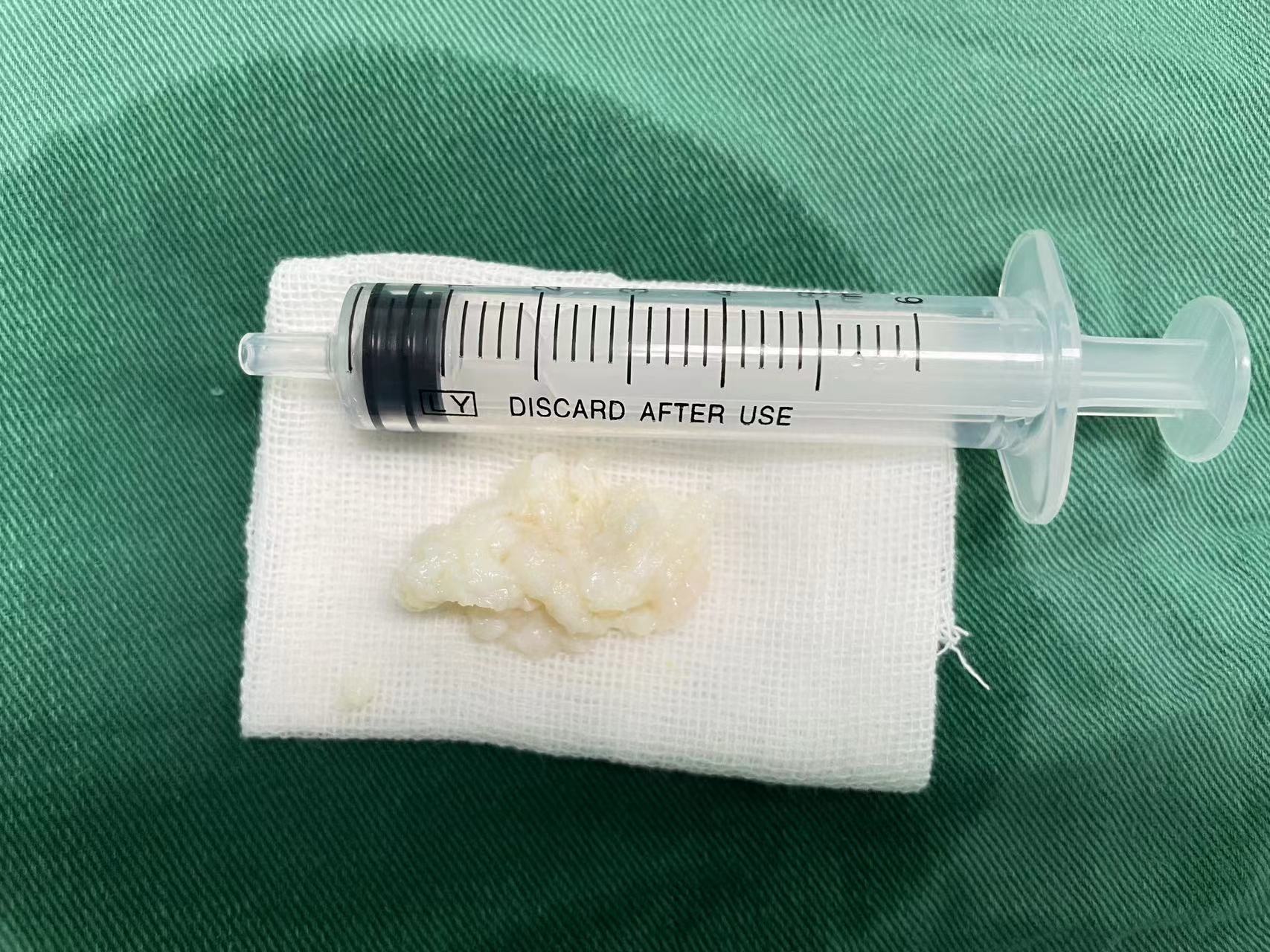 广西壮族自治区南溪山医院全麻内镜下精准摘除腰椎间盘突出