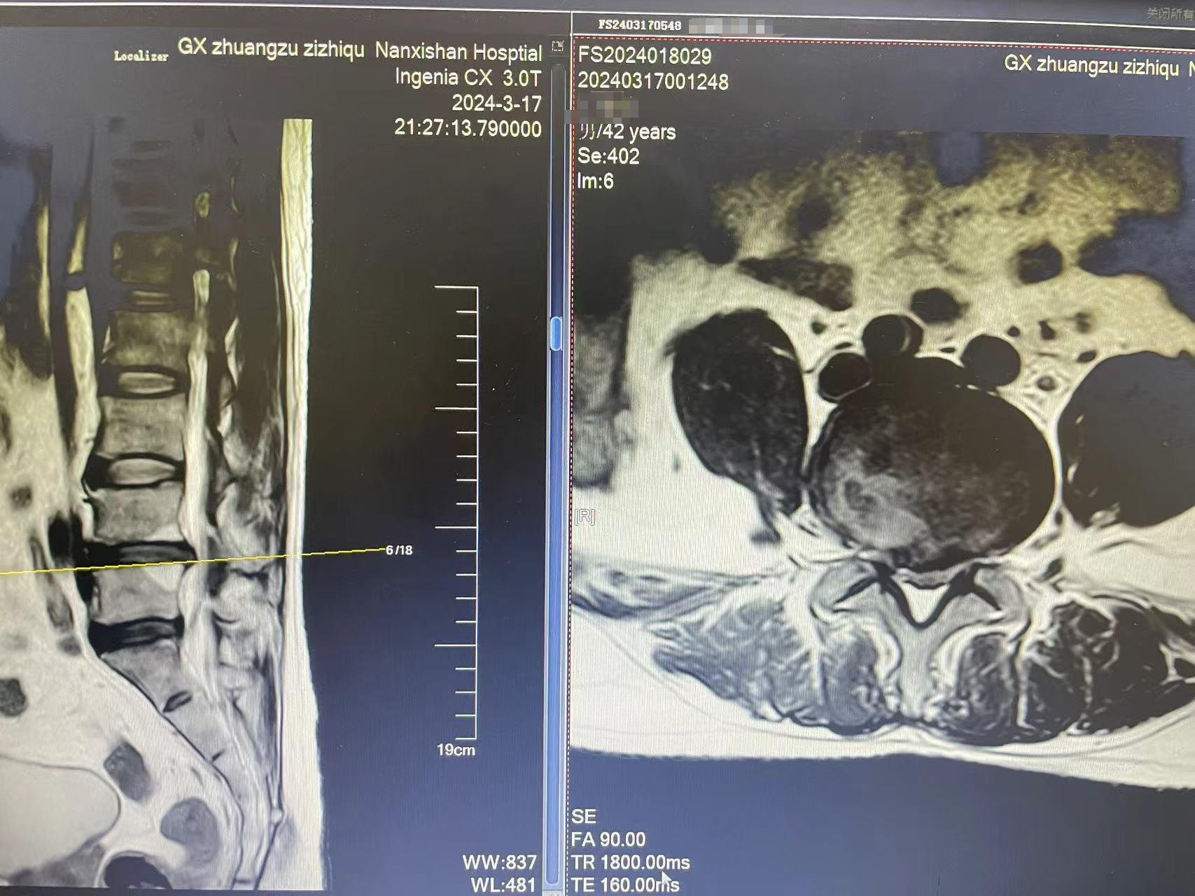 广西壮族自治区南溪山医院全麻内镜下精准摘除腰椎间盘突出