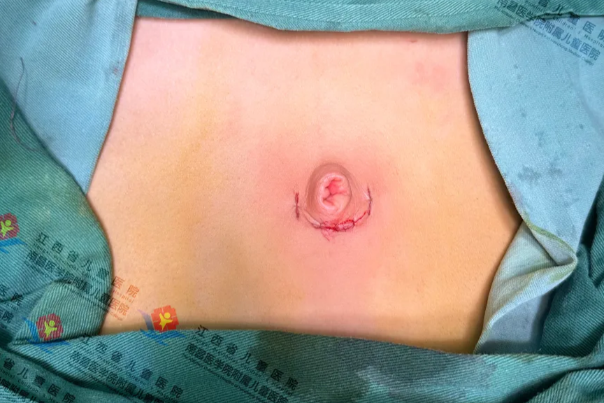 9 岁女童卵巢肿瘤「柚子大」，整个膀胱被压迫成扁平状......
