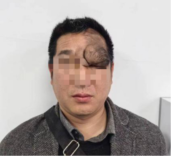 额头小胎记 32 年后变「毛桃」样巨瘤 医生为男子摘瘤补皮修复容貌