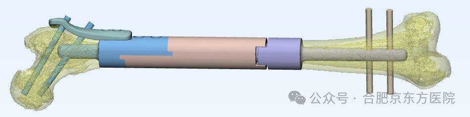 合肥京东方医院 3D 打印技术 为癌转移患者「换骨」