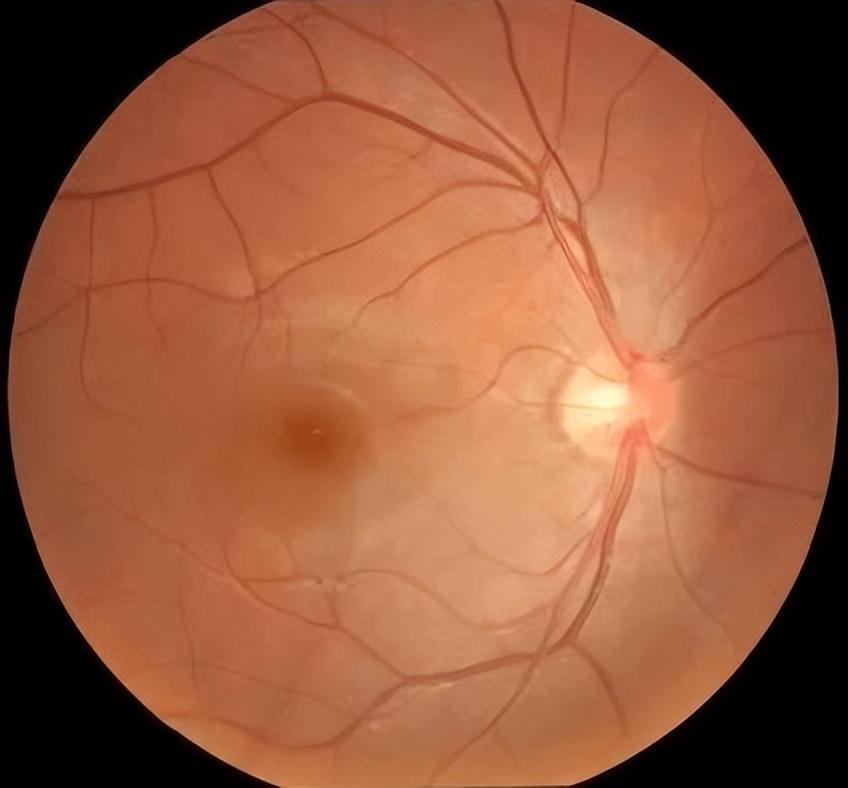 每天一杯「续命」奶茶？武汉普瑞眼科提醒你小心「糖网」