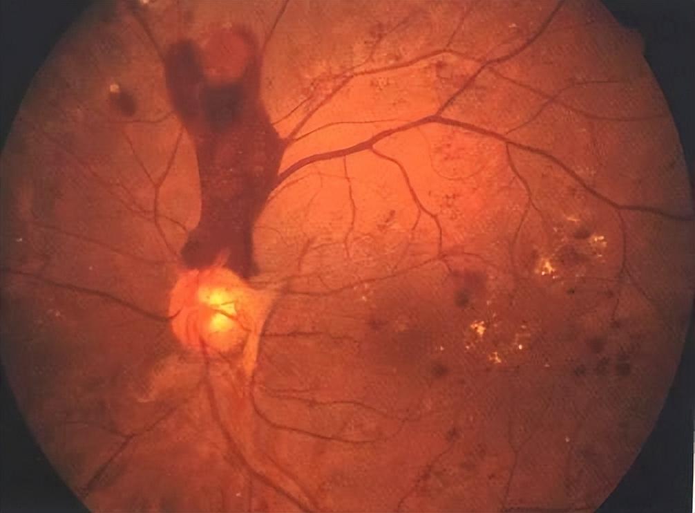 每天一杯「续命」奶茶？武汉普瑞眼科提醒你小心「糖网」