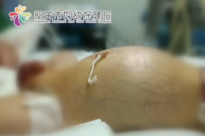 韶关市妇幼保健院打胜出生 3 天宝宝胃裂口 5 cm 的保「胃」战
