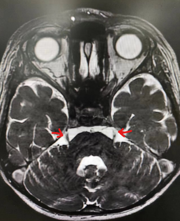 南昌大学二附院成功治愈一例罕见带状疱疹后遗症患者