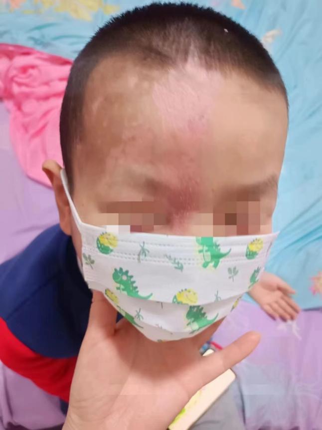 南昌大学二附院成功治愈一例罕见带状疱疹后遗症患者