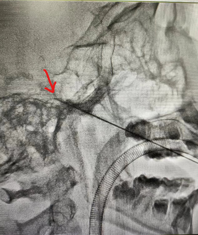 南昌大学二附院成功治愈一例罕见带状疱疹后遗症患者
