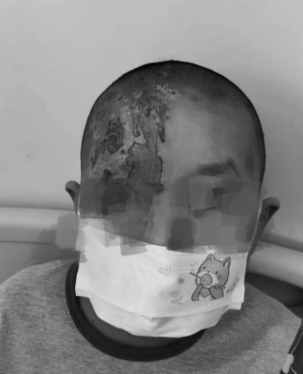 南昌大学二附院成功治愈一例罕见带状疱疹后遗症患者