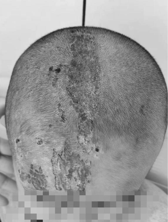 南昌大学二附院成功治愈一例罕见带状疱疹后遗症患者