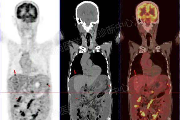 【高尚病例】PET/CT 显像诊断「癌王」胰腺恶性肿瘤一例