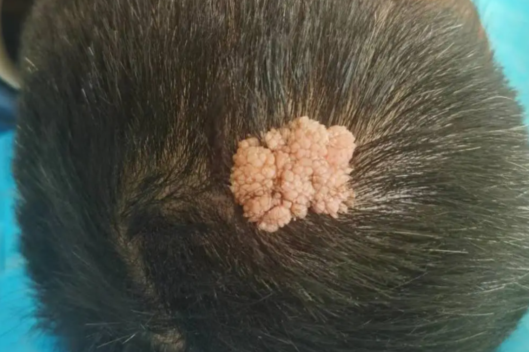 50 岁男子头顶长出巨大「肉菜花」，摸过就可能感染 HPV