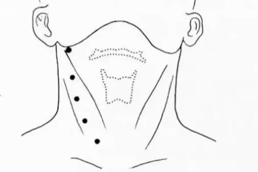 脖子有「小孔」，易感染，可能是鳃裂囊肿及瘘管