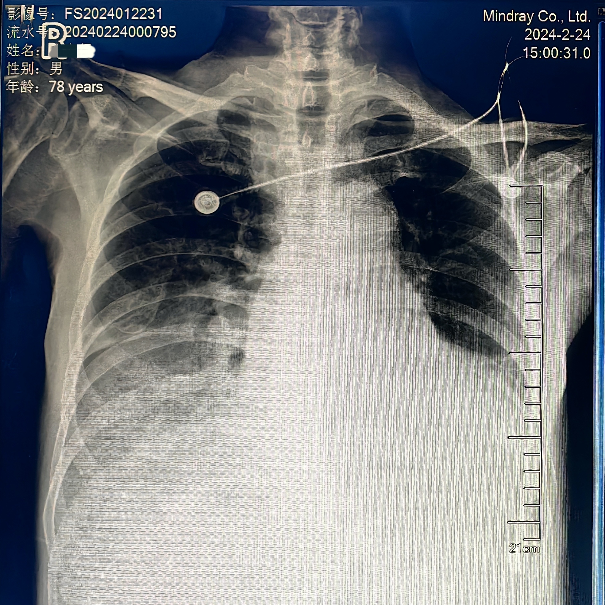 八旬重症瓣膜病患者危在旦夕,南溪山医院团队微创换瓣再创生命奇迹