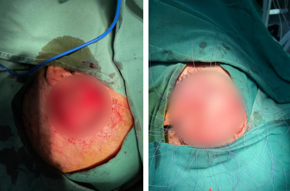 台州市肿瘤医院成功完成一台特殊的整型手术