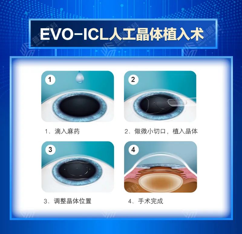 什么是 ICL 晶体植入术？武汉普瑞眼科带你全面了解 ICL 晶体植入术原理