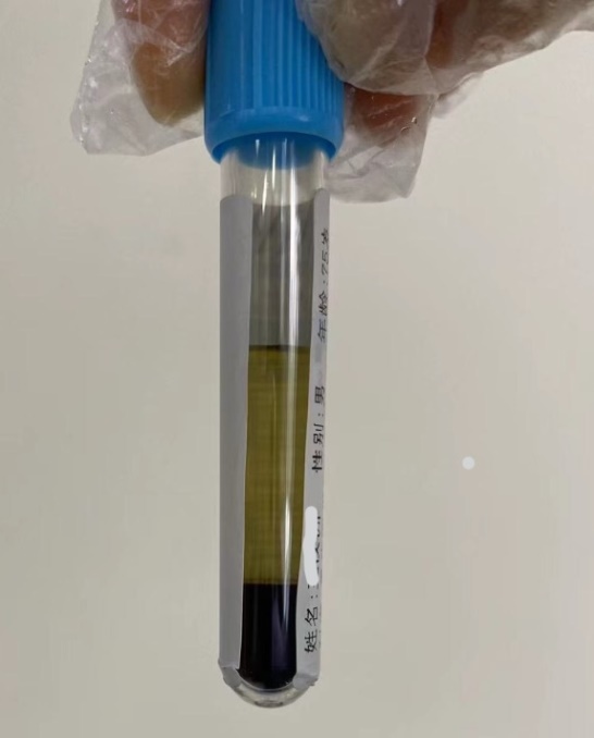 关于一例凝血异常案例分享