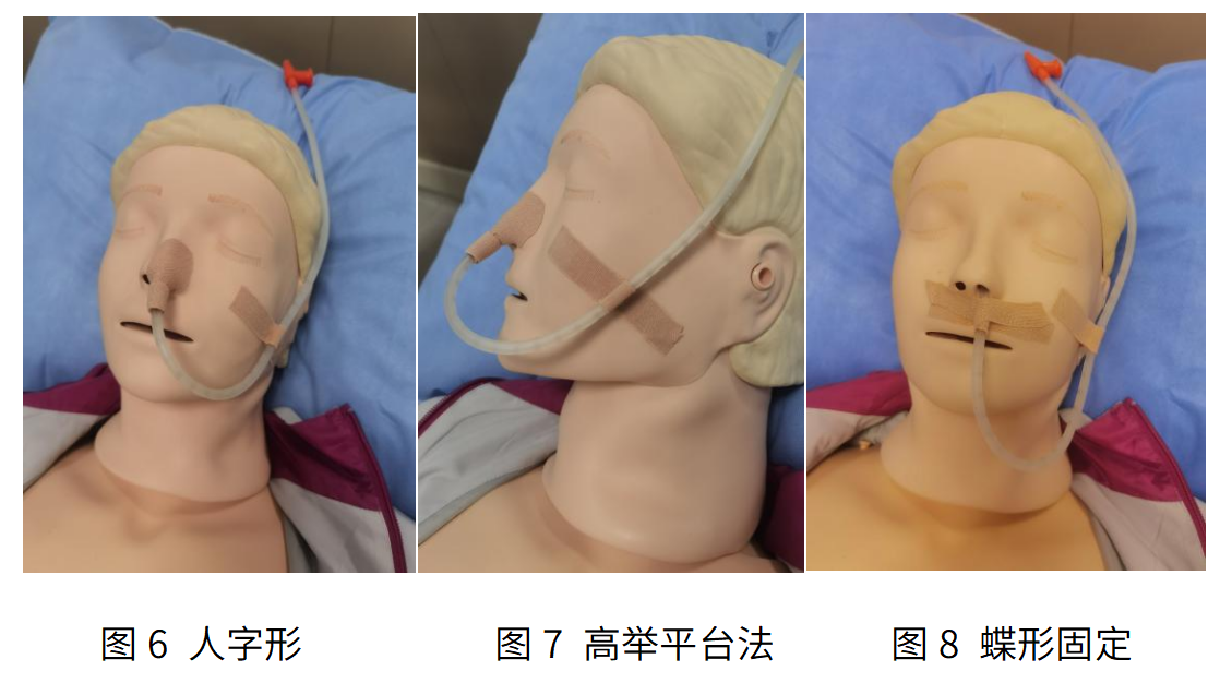 京医科普：成人鼻肠管的留置与维护