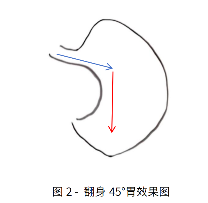 京医科普：成人鼻肠管的留置与维护