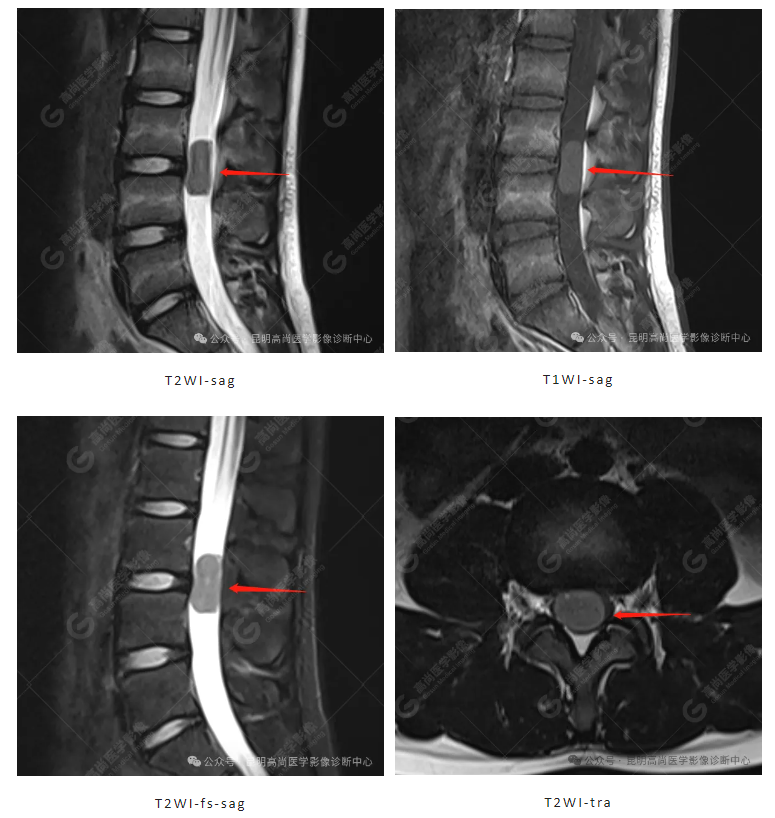 【高尚病例】腰腿痛、下肢麻木... 不可忽视椎管内神经鞘瘤