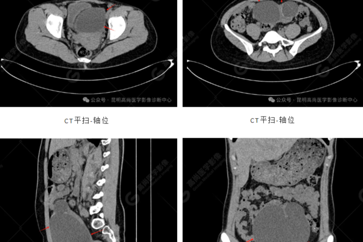 【高尚病例】左侧卵巢浆液性囊腺瘤一例