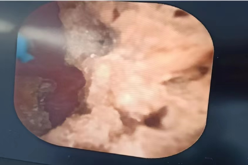 草莓医院创新应用电子输尿管软镜辅助经皮肾镜激光碎石术