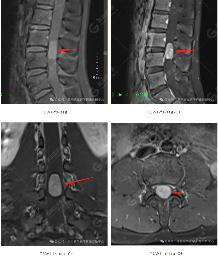 【高尚病例】腰腿痛、下肢麻木... 不可忽视椎管内神经鞘瘤