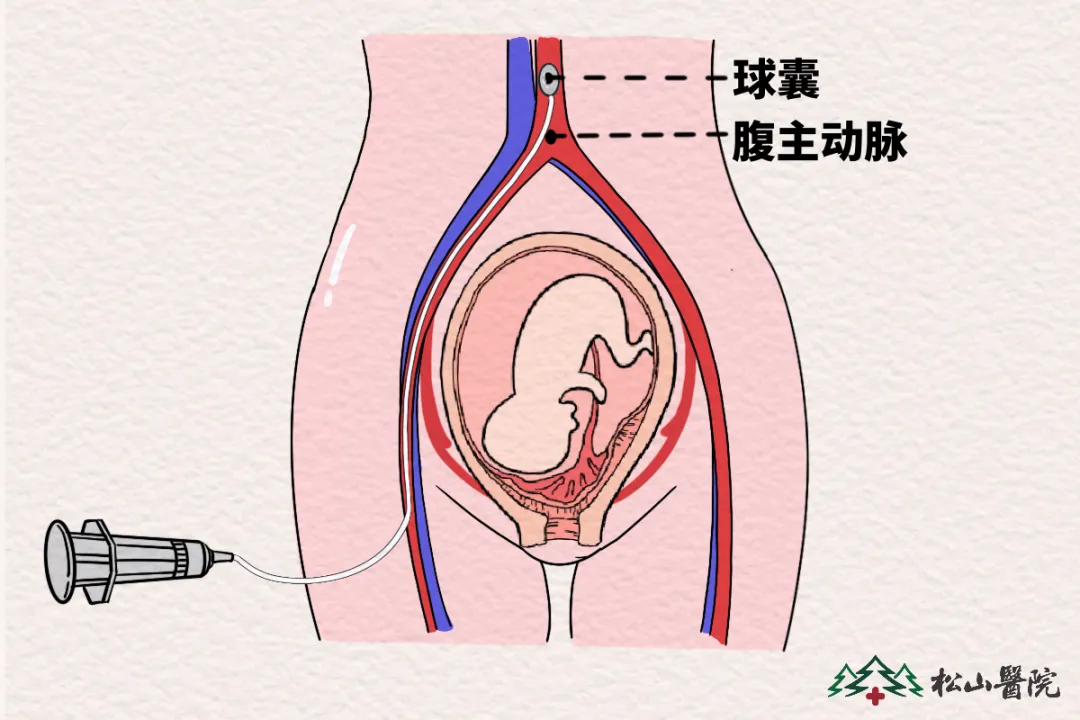 子宫纵隔手术球囊图片图片