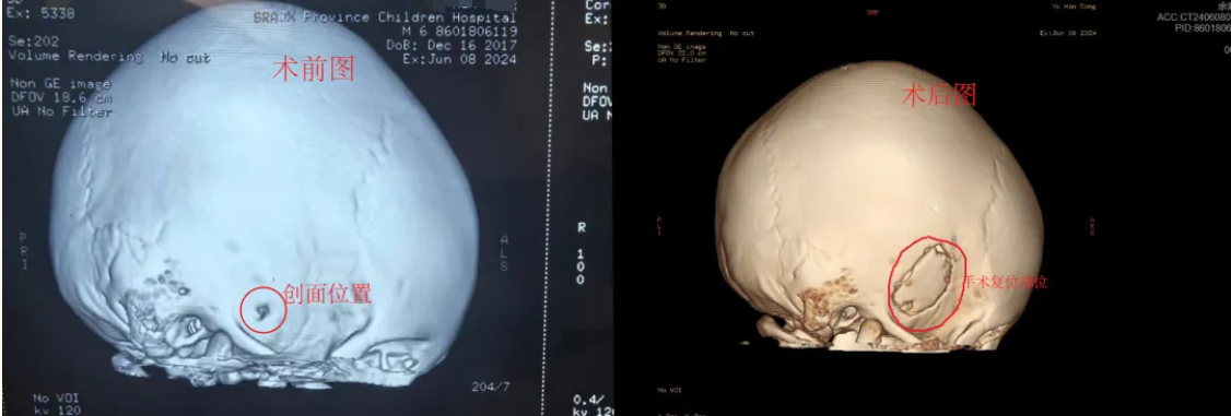 6 岁男童突遭「箭矢惊魂」，「时兴玩具」怎么成「伤人利器」？
