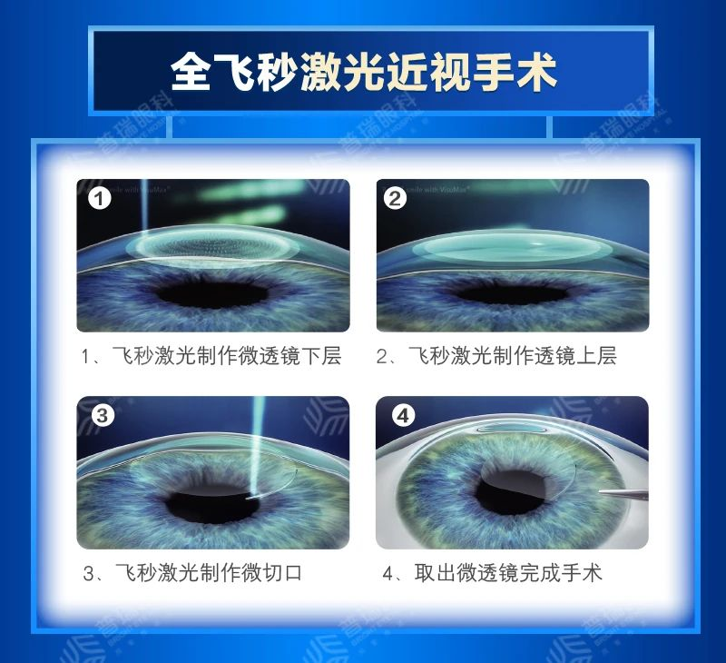 暑期摘镜 近视手术方式有哪些？武汉普瑞眼科医院上攻略啦