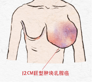 高龄+12 cm 巨型肿块，湖南妇女儿童医院医生妙手除「负担」
