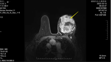 高龄+12 cm 巨型肿块，湖南妇女儿童医院医生妙手除「负担」