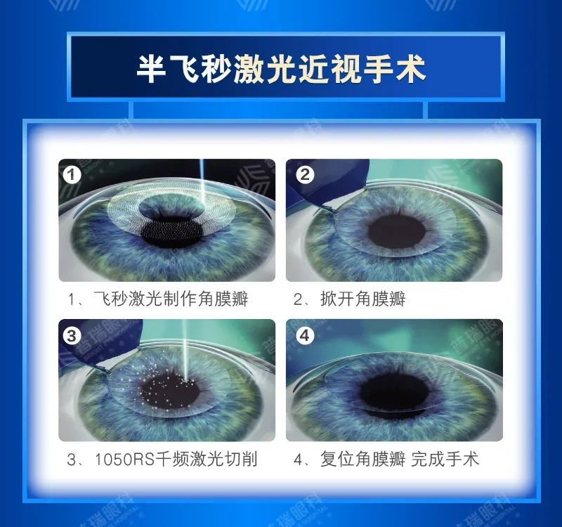 暑期摘镜 近视手术方式有哪些？武汉普瑞眼科医院上攻略啦
