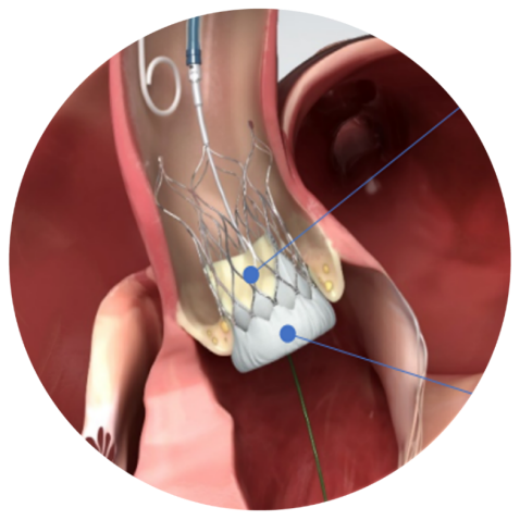 成都京东方医院独立成功完成首例经导管主动脉瓣植入术（TAVI）