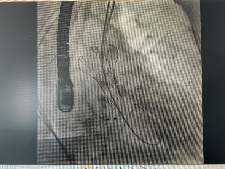 成都京东方医院独立成功完成首例经导管主动脉瓣植入术（TAVI）